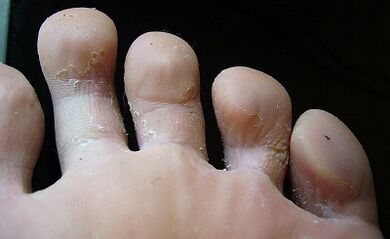 Come si guarda il fungo sulle gambe e come lo tratti