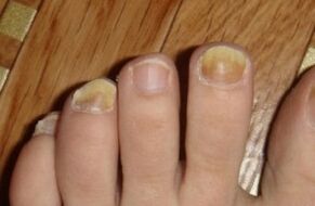 Ingiallimento dell'unghia a causa di funghi